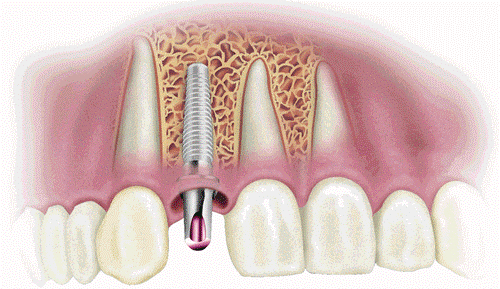 Kỹ thuật trồng răng giả Implant